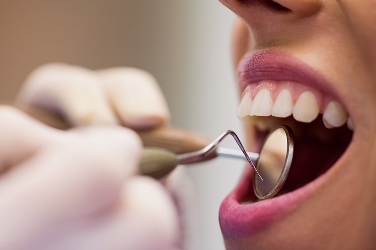 Placca dentale e tartaro: quali sono le differenze?